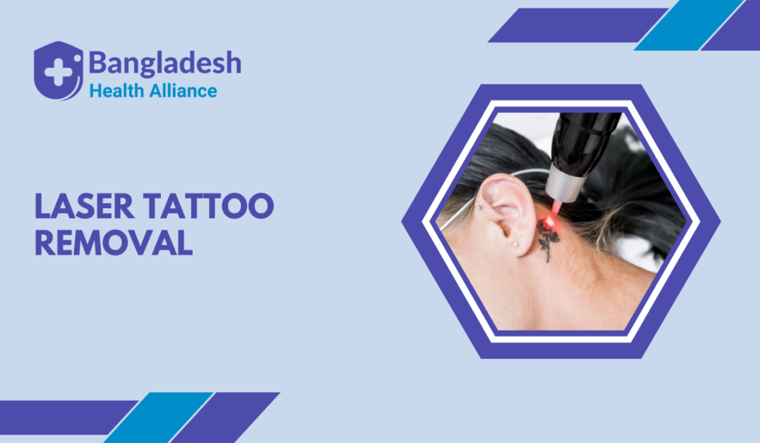 Laser Tattoo Removal in Bangladesh