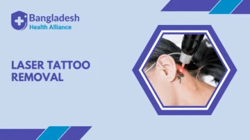 Laser Tattoo Removal in Bangladesh