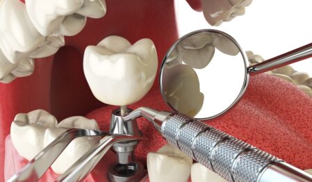 Dental implant cost in Bangladesh