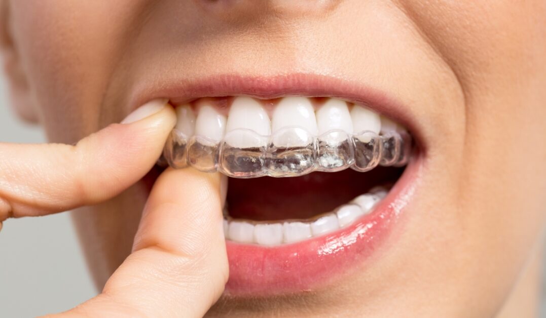 Invisible Braces Cost in Bangladesh