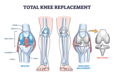 Knee Replacement Surgery Price in Bangladesh