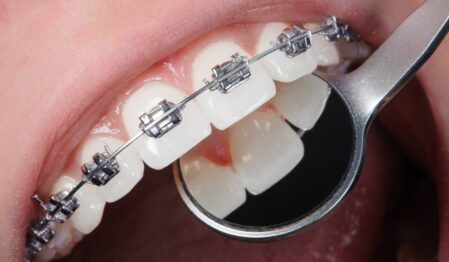 Orthodontic Treatment Cost in Bangladesh