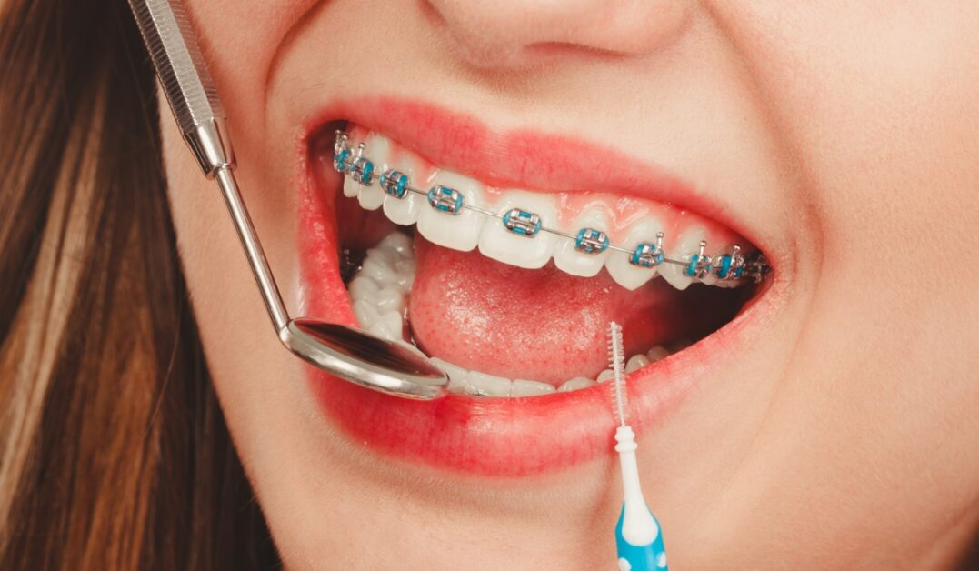 Teeth Braces Cost in Bangladesh