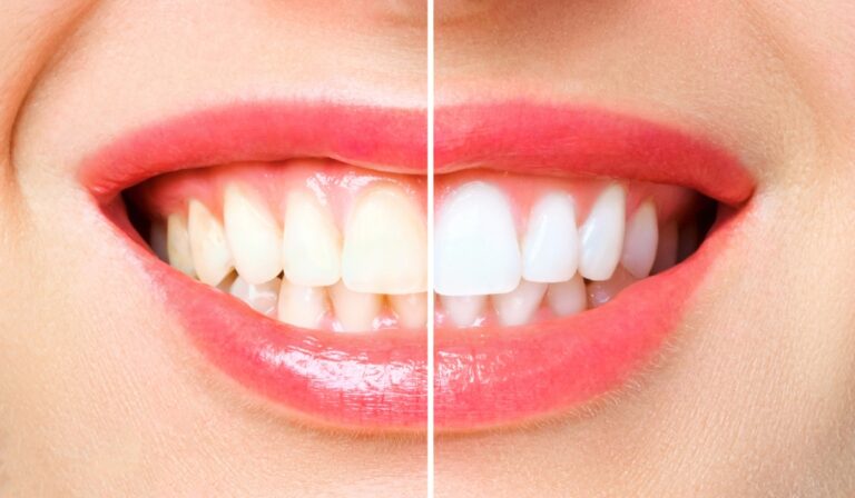 Teeth Whitening Price in Bangladesh