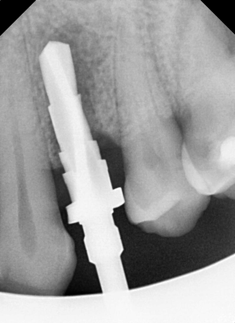 Dental implant