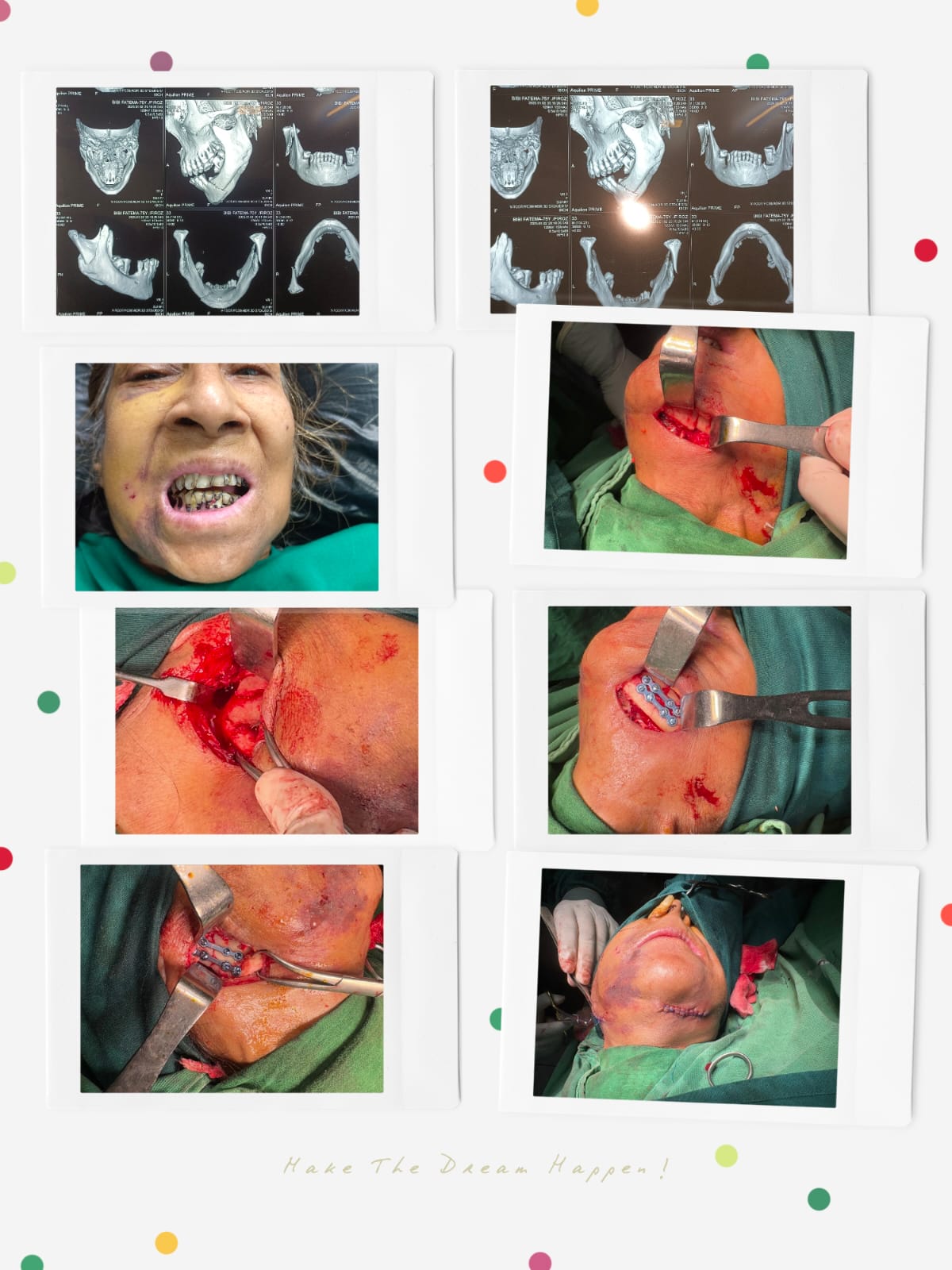 Maxillofacial trauma