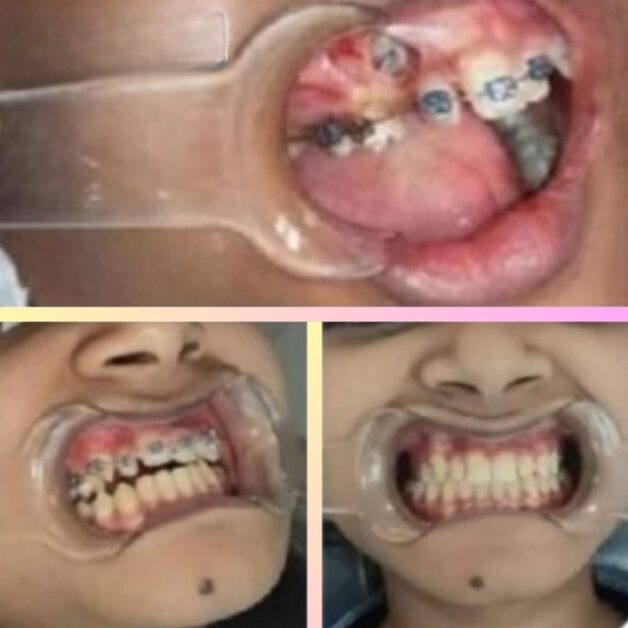 Braces case study of a patient with rotated and overlapping teeth successfully aligned using self-ligating braces under the American Orthodontic Bracing System. 