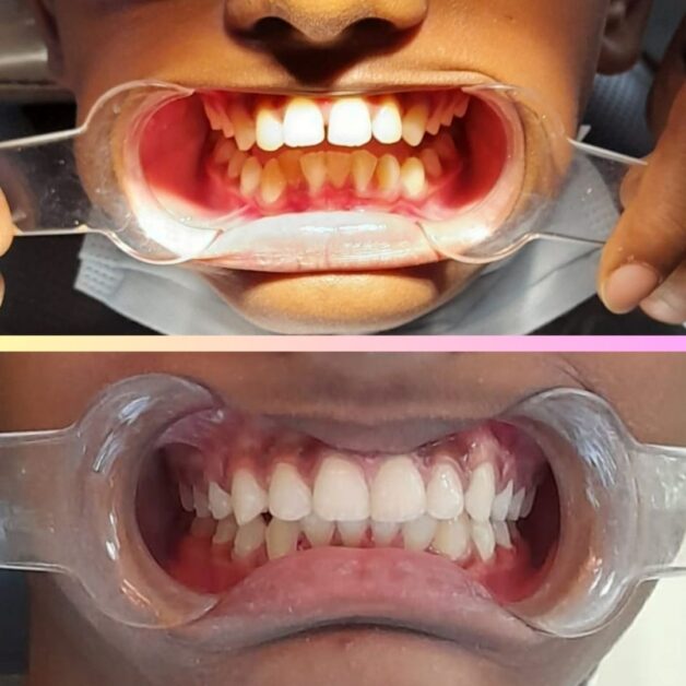Orthodontic treatment showing a teenage patient’s full smile transformation before and after braces with visible improvement in alignment and bite correction. 