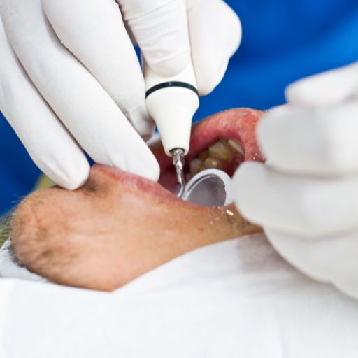Preventive Cleaning & Prophylaxis
