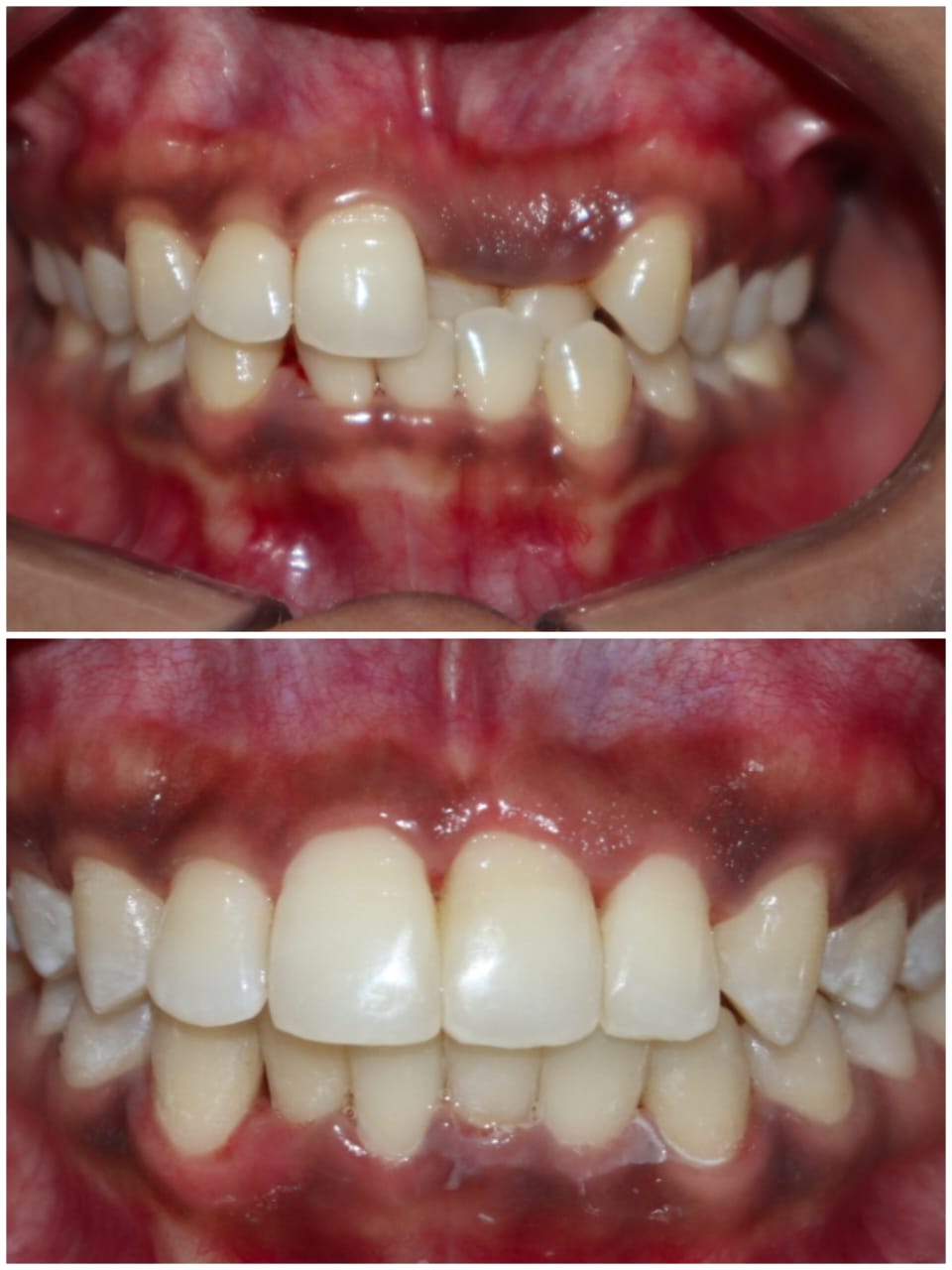 Case 1 - Anterior Crowding with Crossbite