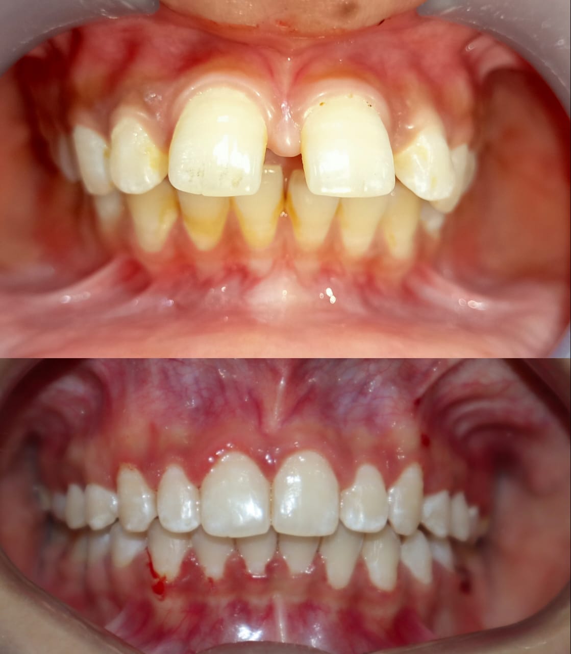 Case 2 - Spacing and Deep Overbite