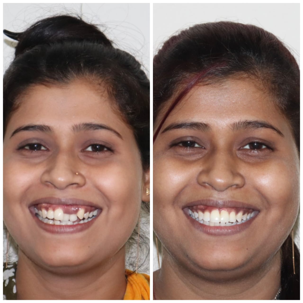 Case 3 - Smile Makeover