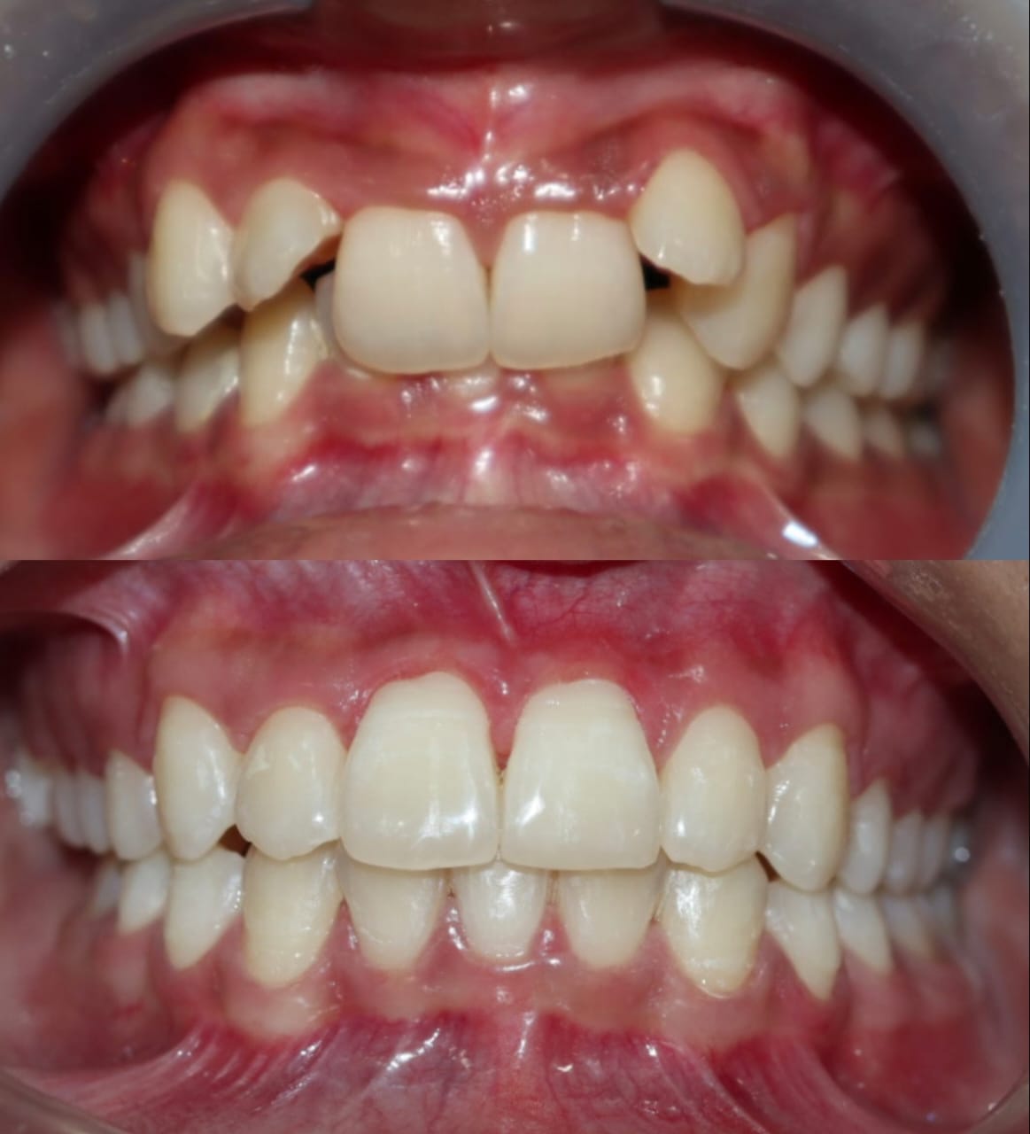 Case 4 - Canine Crossbite