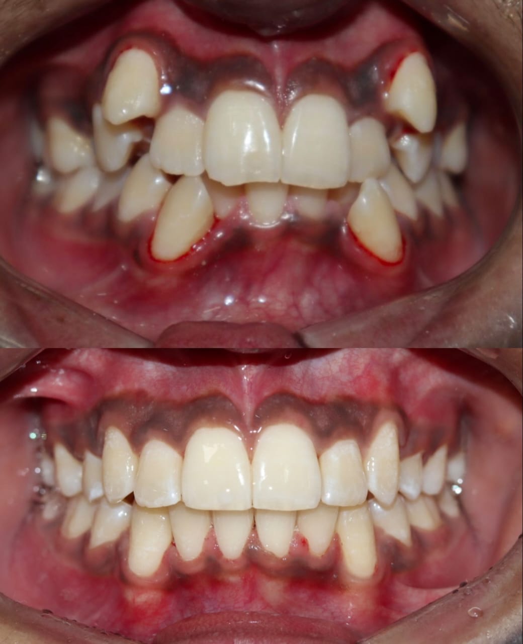 Case 6 - Crowded Arch