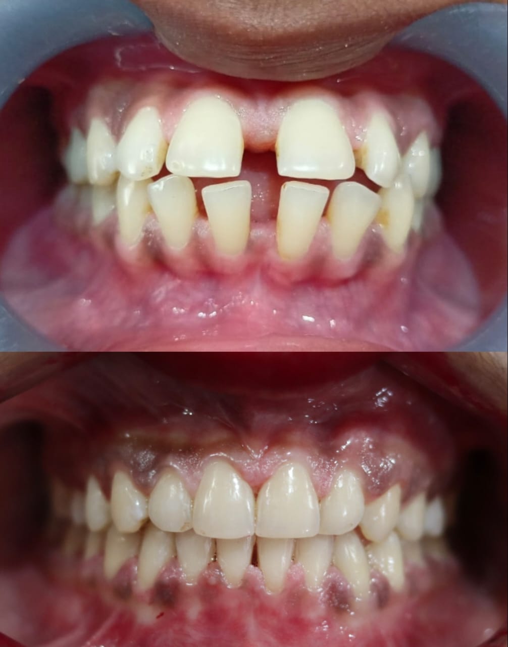 Case 8 - Diastema Crowding