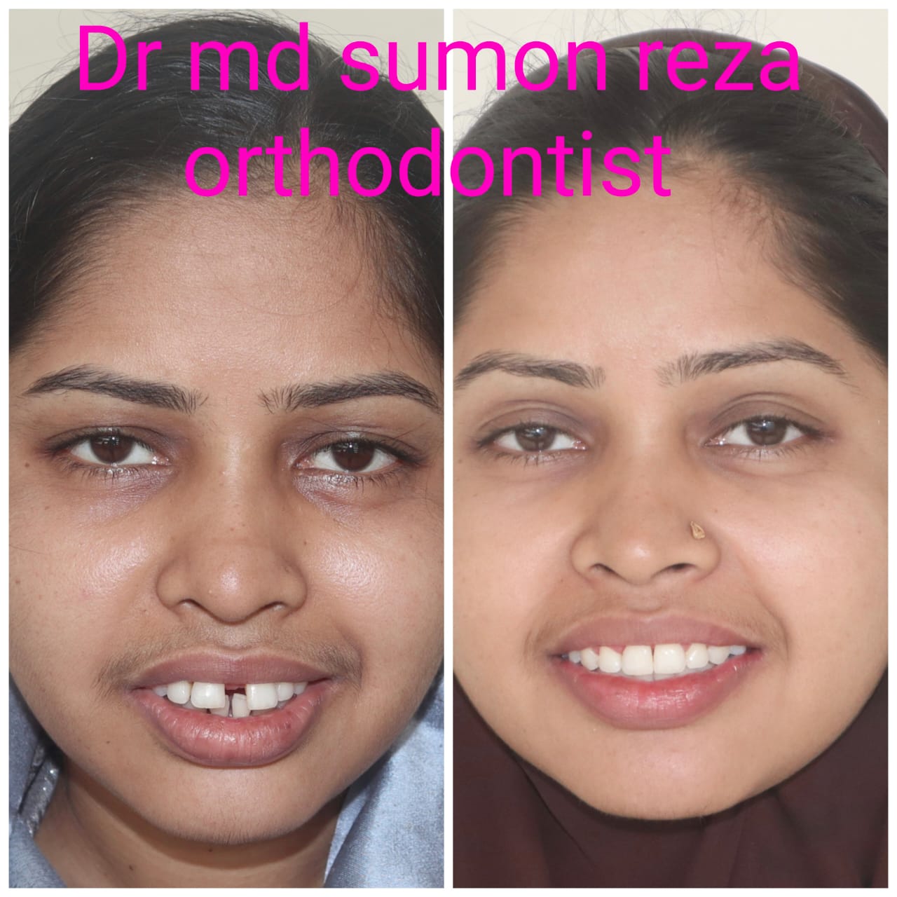 Case 9 - Midline Gap
