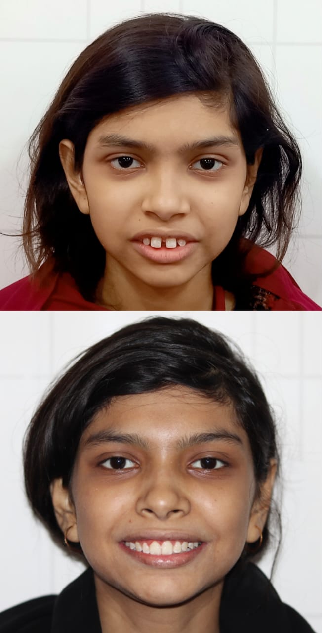 Case 10 - Child Midline Correction