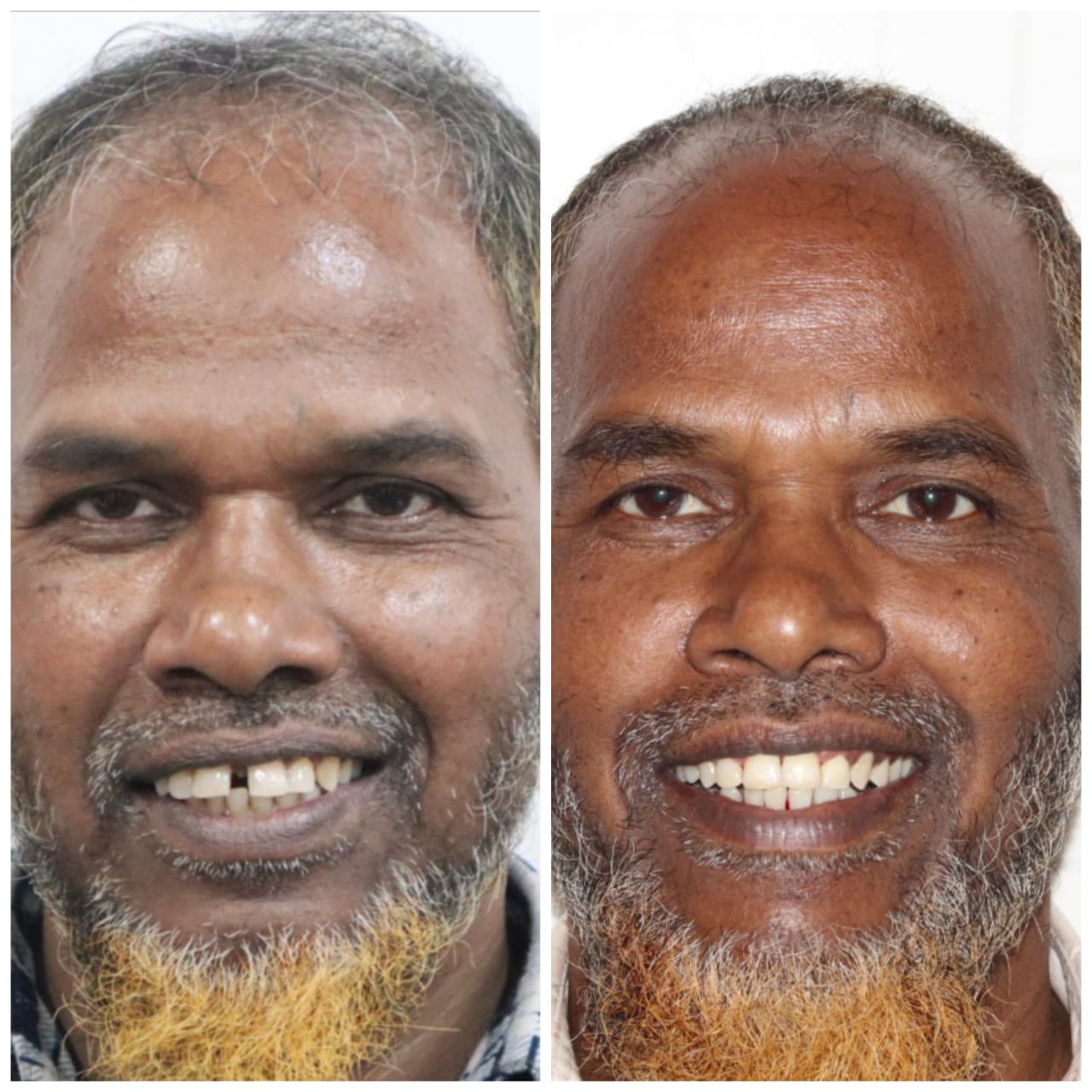 Case 12 - Missing Incisors