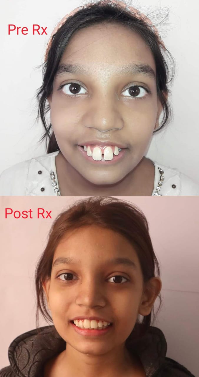 Case 13 - Protruded Incisors