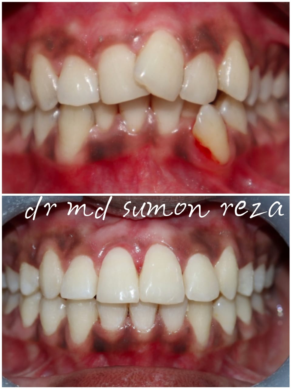 Case 14 - Labioversion Correction