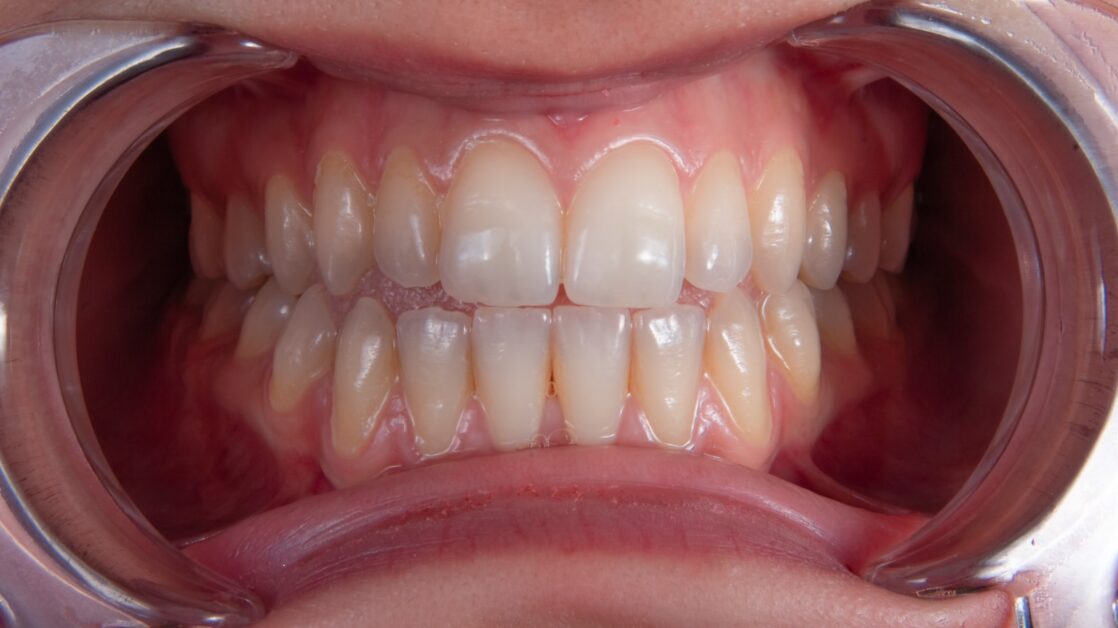 a person's mouth with teeth