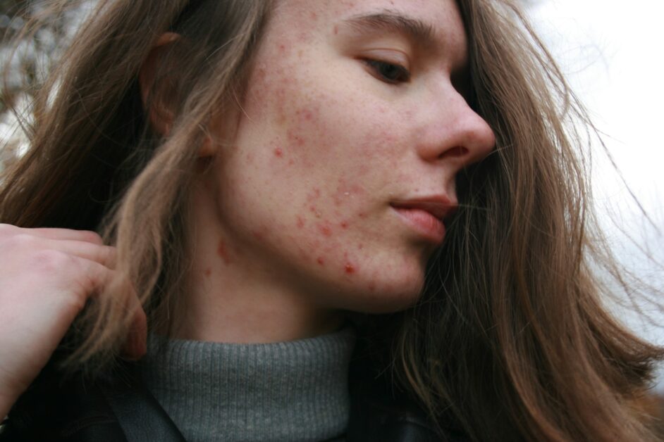 Skin Conditions