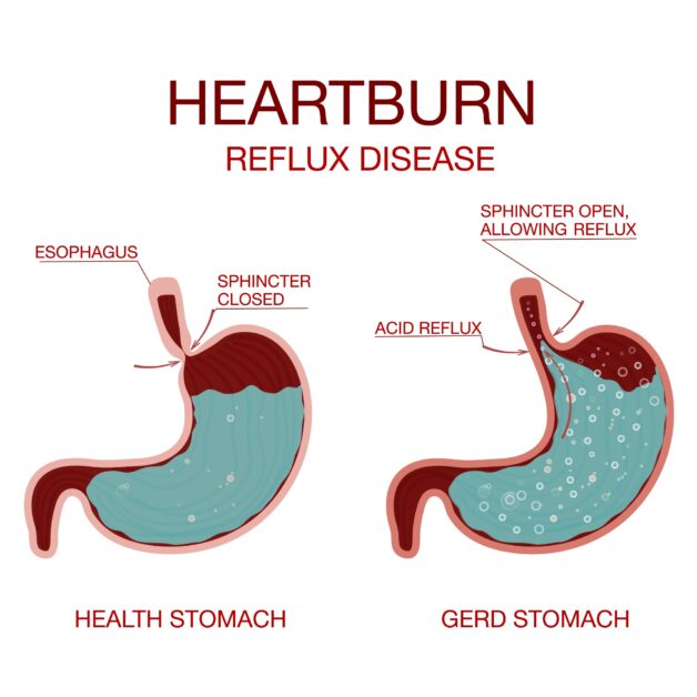 Gastroesophageal Reflux Disease (GERD) and Acid Reflux