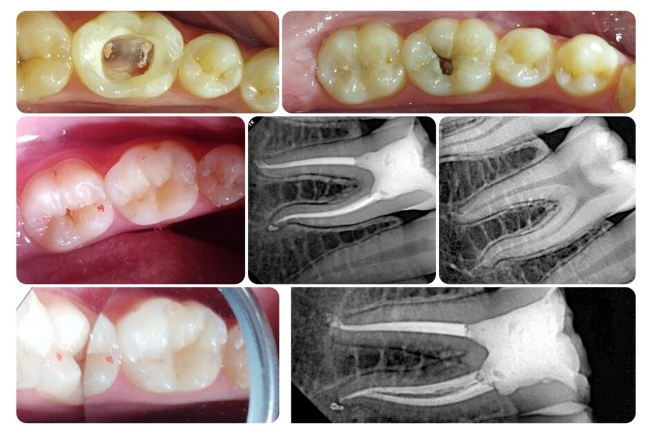 Root canal treatment