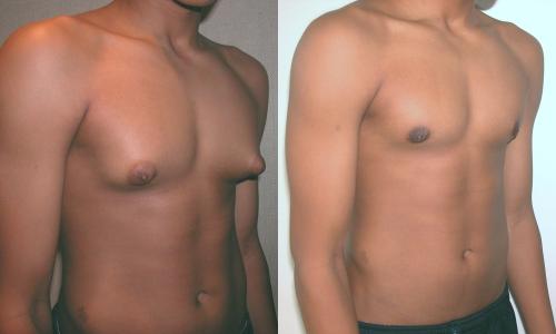 Gynecomastia