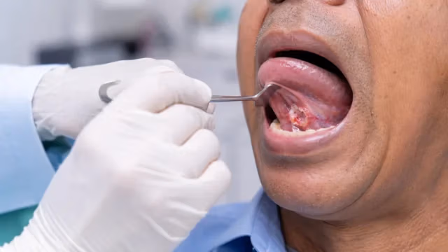 Clinical examination of floor-of-mouth cancer with an oral lesion under the tongue