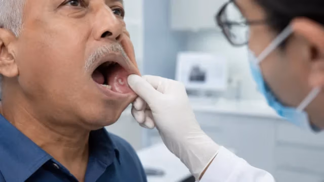 Clinical examination of gum cancer inside the mouth during an oral cancer check-up in Dhaka