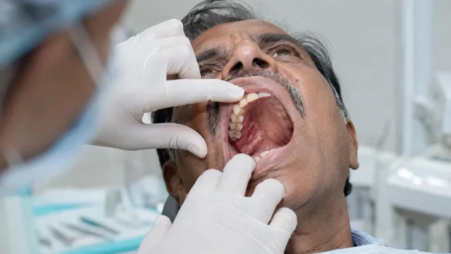 Clinical examination of hard-palate and retromolar cancer inside the upper mouth