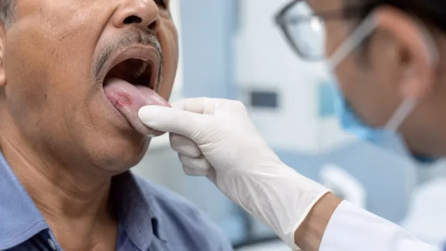 Clinical examination of tongue cancer inside the mouth during an oral cancer screening in Dhaka